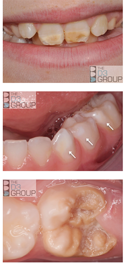 D3 Group Developmental Dental Defects What Is Molar Hypomin