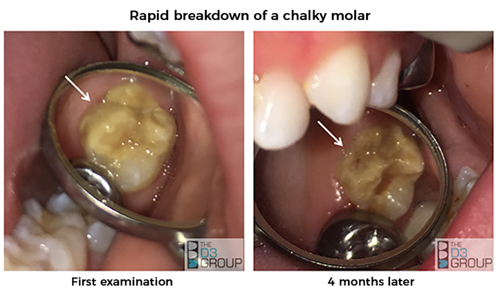 5 year 2024 old molars